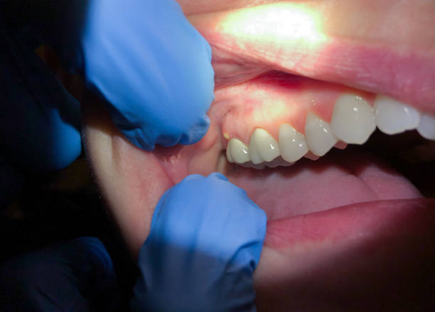 Best Emergency Gum Treatment in Timmonsville, SC