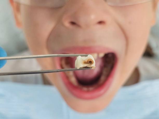 Best Emergency Treatment for Dental Infections or Abscesses in Timmonsville, SC
